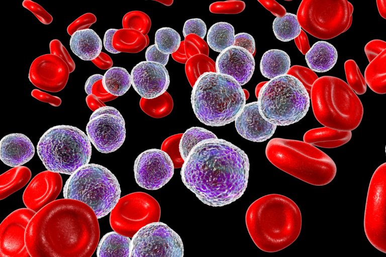 Leucemia Linfoide Aguda