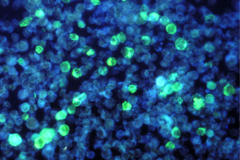 Leucemia Mieloide Crônica