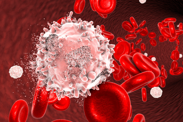 Leucemia Linfoide Crônica